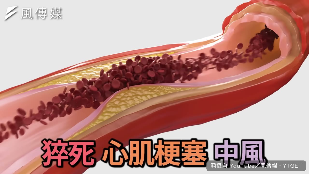 醫師講心肌梗塞病人三個月又塞住